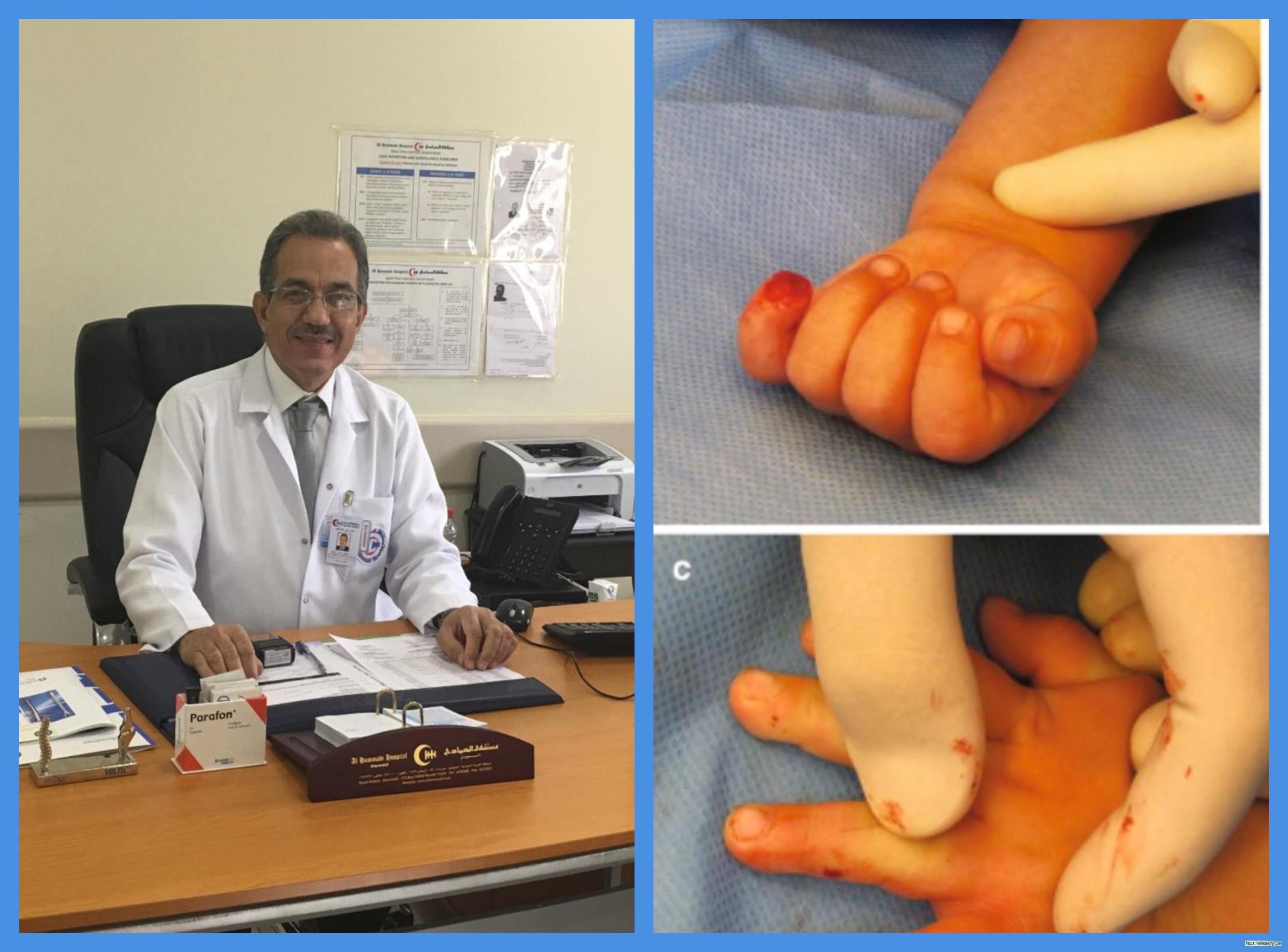 *وجه رسائل تثقيفية للأهل..د.صبري زيادة استشاري جراحة العظام بمستشفيات الحمادي:*  *إصابات أطراف الأصابع عند الأطفال شائعة..والتعامل الصحيح معها يعطي نتائج ممتازة*