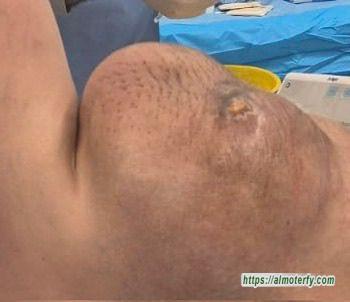 مدينة الملك سعود الطبية تنفّذ عملية جراحية دقيقة لاستئصال ورم الساركوما