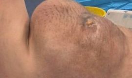 مدينة الملك سعود الطبية تنفّذ عملية جراحية دقيقة لاستئصال ورم الساركوما